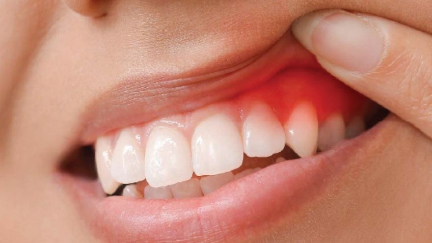 Diş Eti Apsesi Nedir Nedenleri Belirtileri Ve Tedavisi