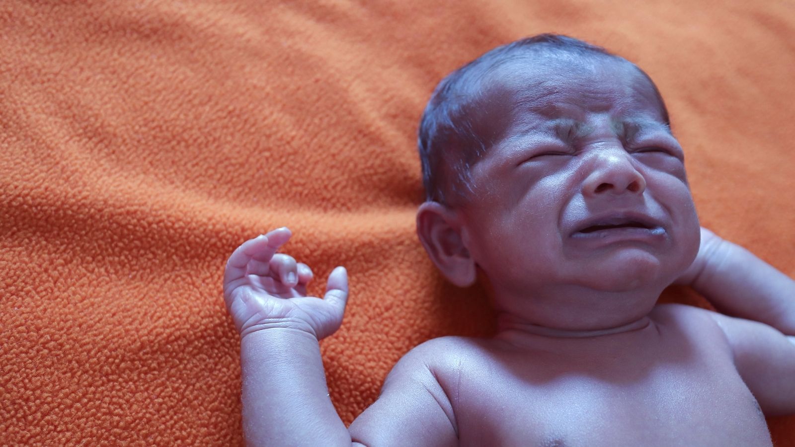 Fallot Tetralojisi Mavi Bebek Hastaligi